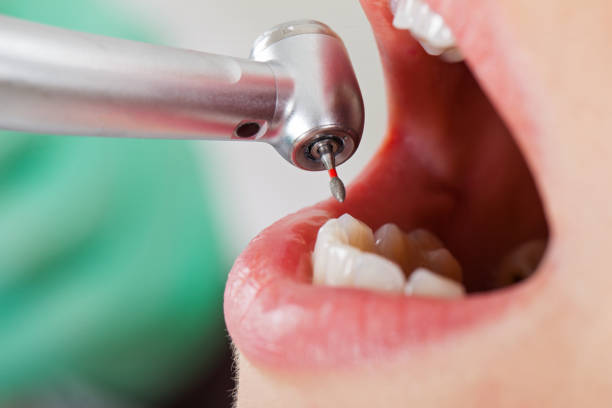 Best Emergency Wisdom Teeth Removal in Washburn, WI